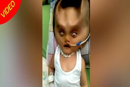 تغییر شکل عجیب صورت نوزاد پس از عمل جراحی!