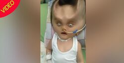 تغییر شکل عجیب صورت نوزاد پس از عمل جراحی!