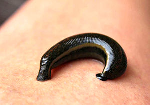 تلاش پزشک برای بیرون کشیدن زالو از بینی مرد کشاورز