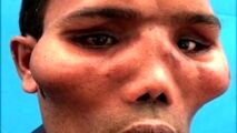 تغییر شکل عجیب صورت مرد جوان در اثر یک عارضه نادر!