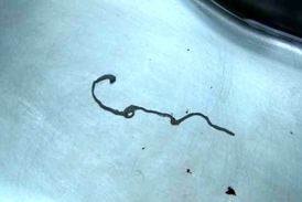 کرم انگلی که ۳۰ سال در جمجمه یک بیمار جا خوش کرده بود! 