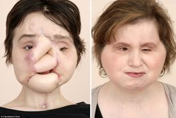 عمل پیوند صورت، دختر جوان را به زندگی عادی برگرداند