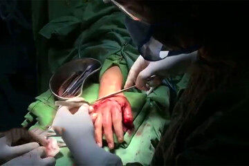 مراحل پیوند دست زن شیرازی که با ساطور قطع شده بود 